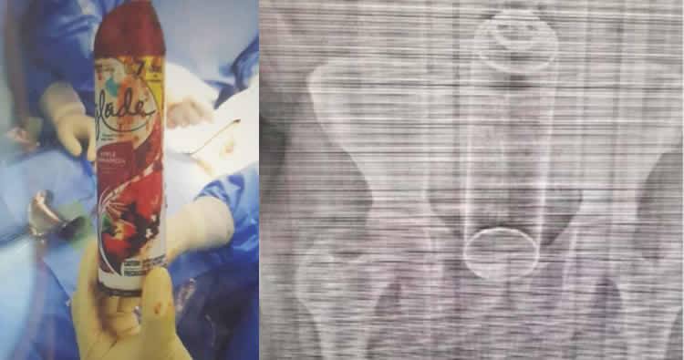 Sancionarán médico residente que subió a las redes radiografía de paciente con ‘Glade’ en el ano
